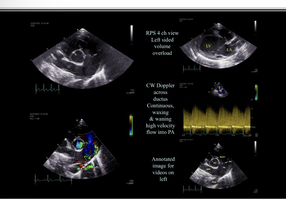 <p>Patent ductus arteriosus - US</p>