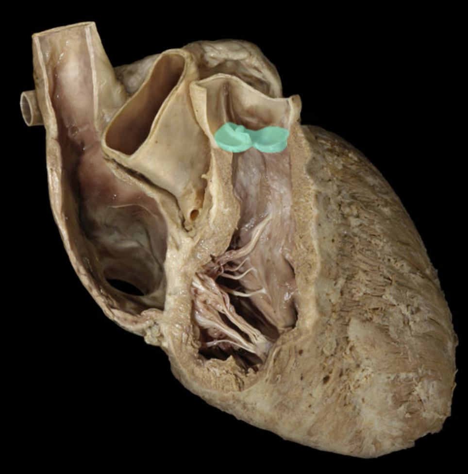 <p>Identify the feature of the right ventricle</p>