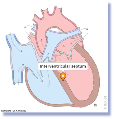 <p>Interventricular septum </p>