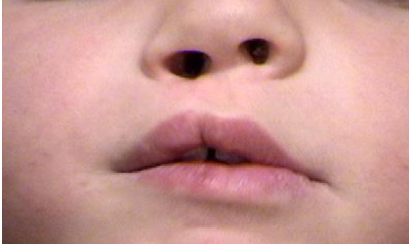 <ul><li><p>mildest form of cleft lip</p></li><li><p>it occurs when the lip tissue fuses almost completely in the womb, leaving behind only a subtle notch, groove, or scar-like mark on the upper lip rather than an open gap</p></li></ul><p></p>