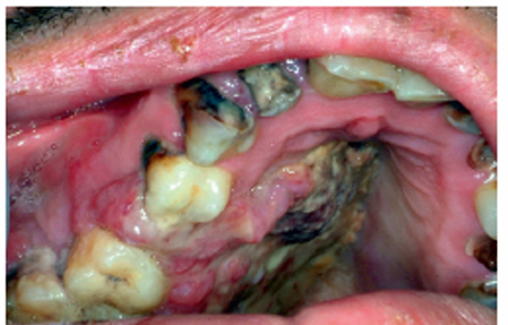 <p>1.what is this lesion?</p><p>2. how to treat/ manage it?</p><p>3. classification of oral lesion in HIV?</p>