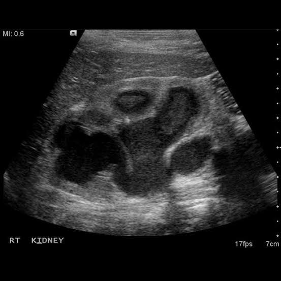 <p>pus within collecting system </p><ul><li><p>usually secondary to long standing ureteral obstruction from calculus </p></li></ul><p></p><p>shows low level echoes with a fluid-debris level</p><p></p>