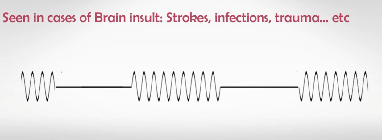 <p>rapid panting followed by apnea (stroke)</p>