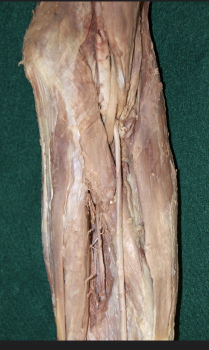 <p>What muscle is that thin tendon</p>