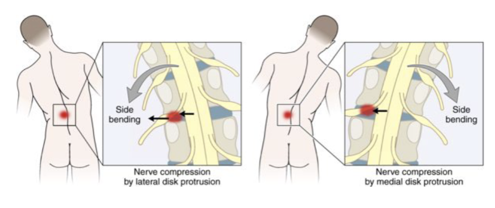 <p>Herniation behaves differently depending weather it is medial or lateral </p>