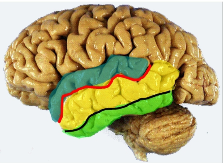 <p>On the lateral surface the temporal lobe is composed of:</p><ul><li><p><mark data-color="#1c6bbb" style="background-color: rgb(28, 107, 187); color: inherit;">Superior</mark>, <mark data-color="yellow" style="background-color: yellow; color: inherit;">middle</mark>, and <mark data-color="green" style="background-color: green; color: inherit;">inferior</mark> temporal gyri</p></li><li><p>Separated but the superior and inferior temporal sulci. </p></li></ul><p></p>
