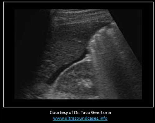 <p>The findings on the image are expected in patients with:</p><p>A. normal ovulation</p><p>B. twin gestation</p><p>C. multiple large uterine fibroids</p><p>D. ovarian hyperstimulation syndrome</p>