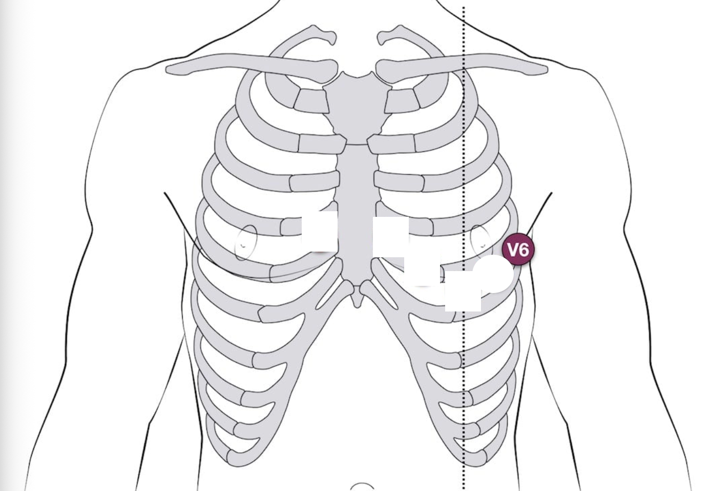 <p>V6 placement - 12-lead EKG</p>