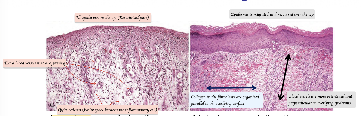 <p><strong>Immature </strong>granulation tissue:</p><ul><li><p><strong>Many inflammatory cells</strong></p></li><li><p><strong>No epidermis (Keratinised) </strong>on the top layer </p></li><li><p><strong>Little collagen</strong></p></li><li><p><strong>Oedema</strong> (White space between the inflammatory cells)</p></li><li><p><strong>Newly blood vessels</strong></p></li></ul><p></p><p><strong>Maturing </strong>granulation tissue:</p><ul><li><p><strong>Fewer inflammatory cells</strong></p></li><li><p>Epithelialisation completed </p></li><li><p>More <strong>organised collagen</strong> (<strong>Parallel </strong>to overlying surface)</p></li><li><p>More<strong> organised blood vessels</strong> (<strong>Perpendicular</strong> to the tissue surface)</p></li></ul><p></p>