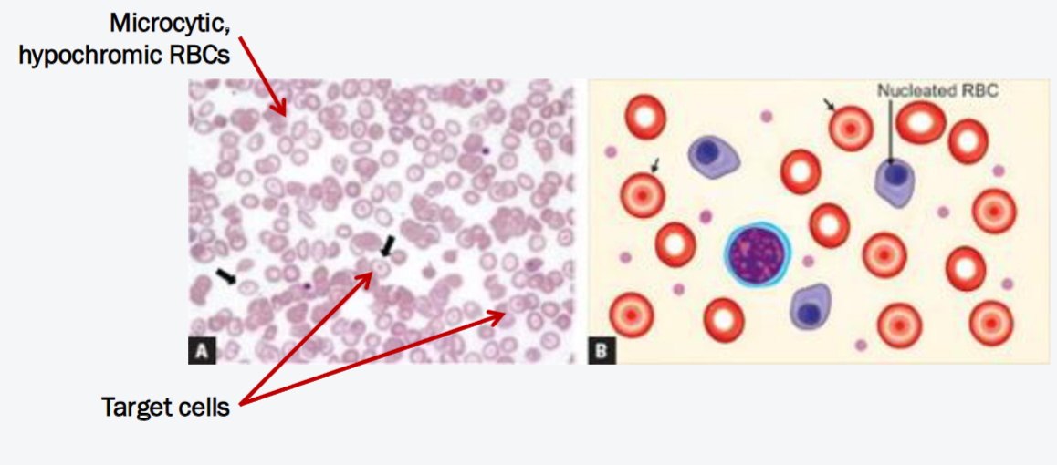<p>What anemia do these peripheral blood smears indicate?</p>