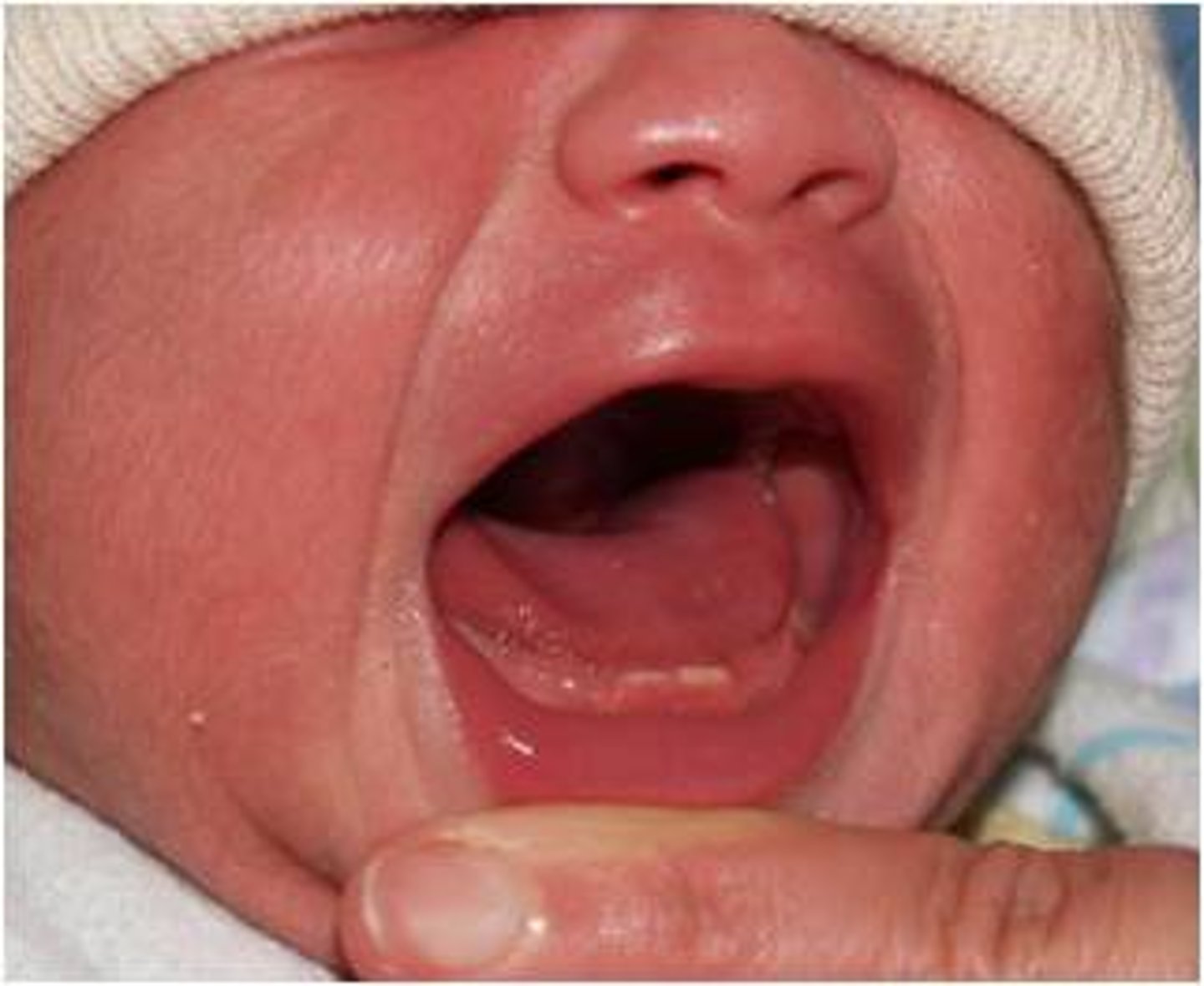 <p>Primary mandibular incisors often just a single tooth.</p><p>Consider extraction, if not well secured and may result in aspiration. Can be associated with Genetic syndromes.</p>