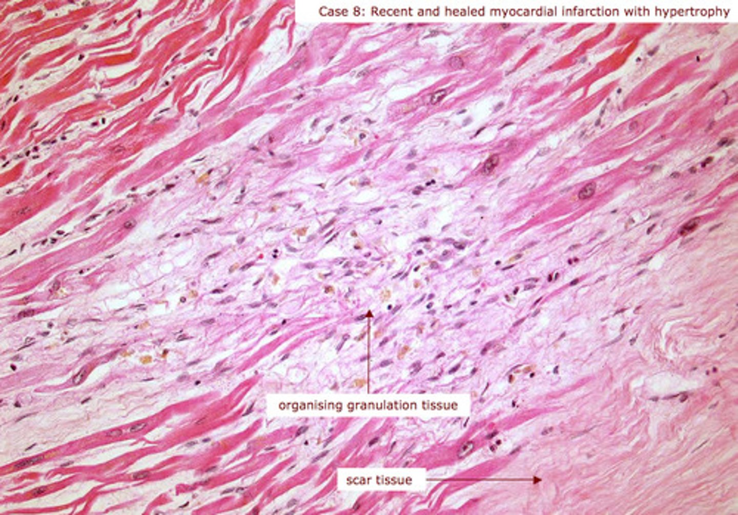 <p>when cardiac striated muscle fibers are damaged by loss of blood supply during aheart attack, tissue becomes necrotic and the fibrous scar tissue develops to form an MI (area of myocardial necrosis)</p>