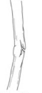 <p>Greenstick Fracture</p>