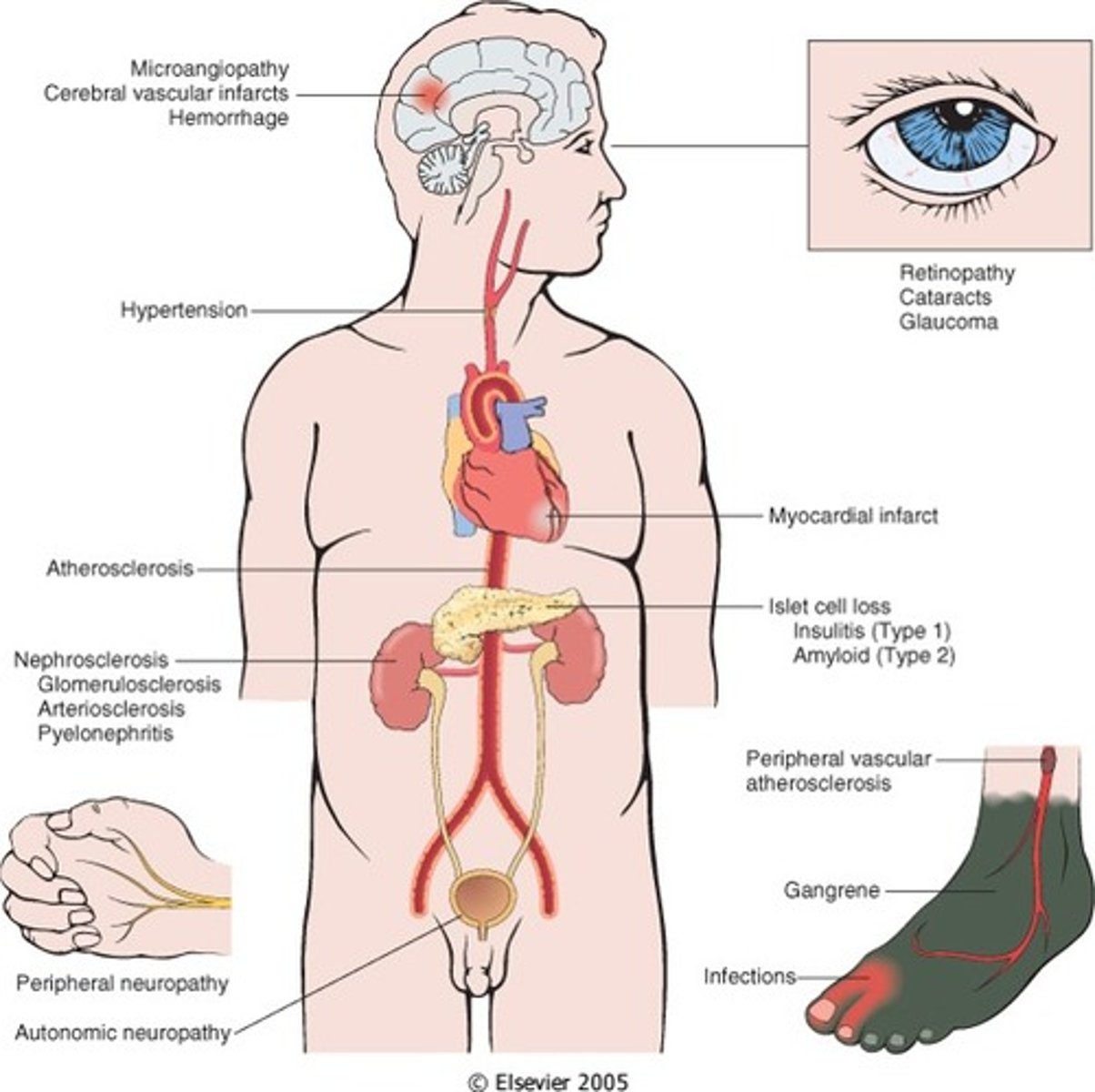 <p>ACUTE:</p><p>- Extremely high blood glucose levels</p><p>- Dangerously low blood glucose levels (often due to medication)</p><p>CHRONIC:</p><p>- Damage to blood vessels, which affects the eyes, kidneys, nerves and the heart.</p>