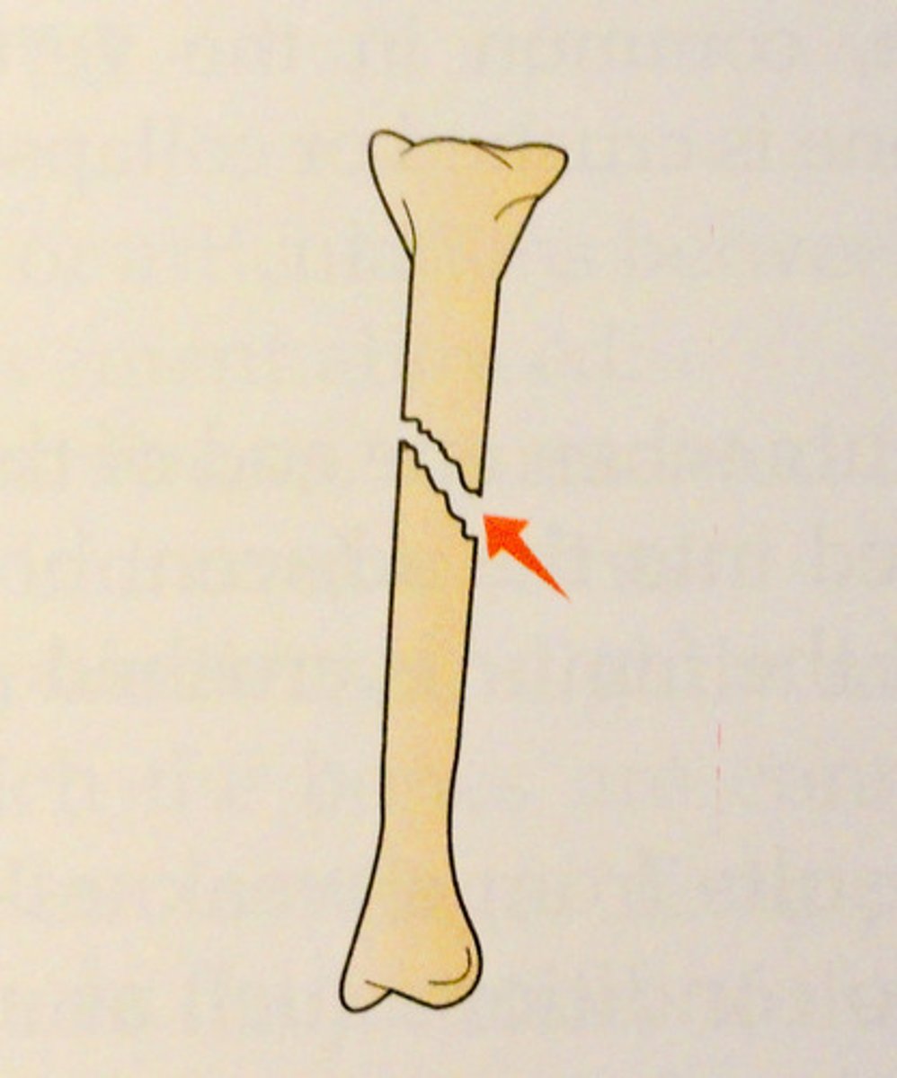 <p>Fx runs oblique to axis of bone</p>