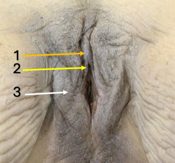 <p>Identify #2</p><p>Side Question:</p><ul><li><p>Encloses which structure?</p></li><li><p>Forms which structure anteriorly?</p></li><li><p>Forms which posteriorly?</p></li></ul><p></p>