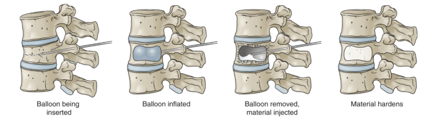 <p><em>For : Compression fractures </em></p><p></p><p><strong>Vertebroplasty </strong>: Injecting bone cement into vertebral body & maintain vertebral body height </p><p></p><p><strong><u>Kyphoplasty </u></strong>: Prior to injecting bone cement, a small inflatable balloon is placed into vertebral body & inflated (compacts bone & creates space for cement) </p><p></p><p><em>Pain relief usually within 24 hours </em></p>