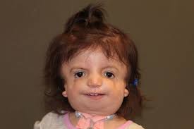 <p>what syndrome?</p>