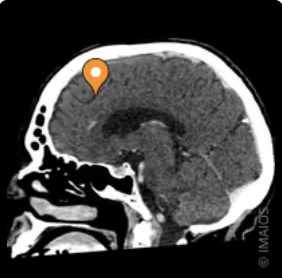 <p>Name the sulcus, modality, and plane</p>
