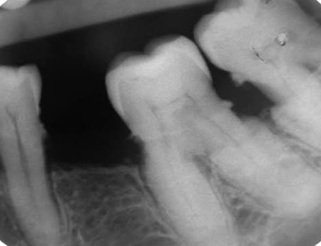 <p>an excessive deposition of cementum on the root surface</p><ul><li><p><strong>produces:</strong></p><ul><li><p>an <span style="color: red;">abnormal root shape</span>.</p></li><li><p>a <span style="color: red;">bulbous enlargement</span> at the root apex.</p></li></ul></li><li><p>may result from:</p><ul><li><p><span style="color: red;">trauma</span><span style="color: red;"> to the PDL</span></p></li><li><p>abnormal developmental processes</p></li><li><p>reactive <span style="color: red;">response to periapical inflammation</span></p></li></ul></li></ul><p></p>
