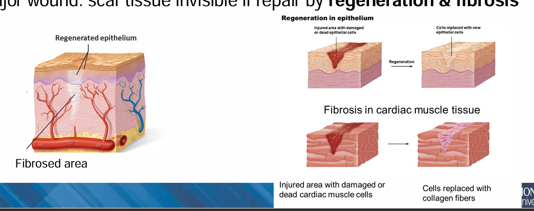 <p><strong>Visible scar</strong></p><ul><li><p>If repair occurs <strong>only by fibrosis</strong></p></li><li><p>Common in <strong>major wounds</strong></p></li></ul><p><strong>Invisible or minimal scar</strong></p><ul><li><p>If repair occurs by <strong>regeneration + fibrosis</strong></p></li></ul><p></p>