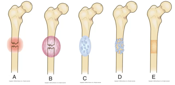 <p>FGCOCR (healing process of fracturos: union)</p>