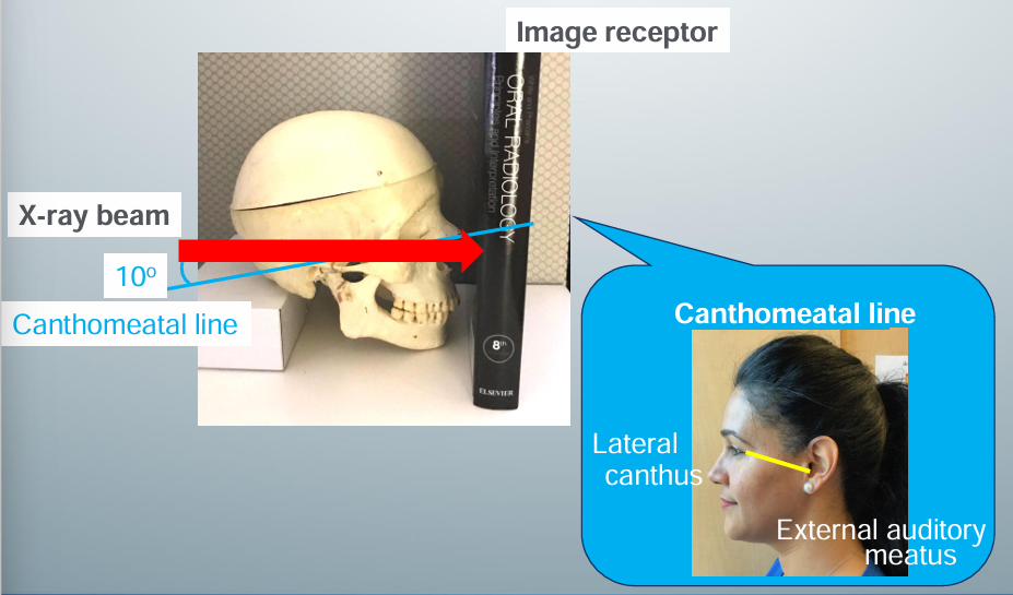 <p>-image receptor perpendicular to pt’s midsagittal plane and parallel to coronal plane</p><p>-pt faces image receptor and tilts head slightly upward so the canthomeatal line forms a 10 degree angle with the transverse plane</p><p>-central x-ray beam positioned centered over the bridge of the nose</p><p>-canthomeatal line: line between the lateral canthus and the external auditory meatus</p>