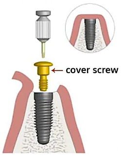 <p><span>The </span><span style="color: rgb(255, 0, 0);">1st stage </span><span>ends by suturing the soft tissues over the implant so that it remains excluded from the oral cavity</span></p><p><span>• Implants are left undisturbed for </span><span style="color: rgb(255, 0, 0);">2-3 months in the mandible and 4-6 months in the maxilla</span></p><p><span>• In the </span><span style="color: rgb(255, 0, 0);">2nd stage</span><span>, the implant is uncovered and titanium abutment is connected to the implant body</span></p>