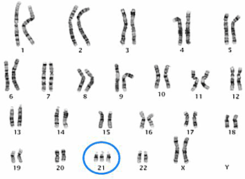 <ul><li><p>In 3 forms: Trisomy 21, mosaicism, tanslocation</p></li></ul><ol type="1"><li><p>Trisomy 21 (95% of cases): 3 complete copies in all cells</p></li><li><p>Mosaicism (1-2% of cases): 3 copies in some but not all cells</p></li><li><p>Translocation (3-4% of cases): Partial copy of chromosome 21 attached to another chromosome</p></li></ol><p></p>