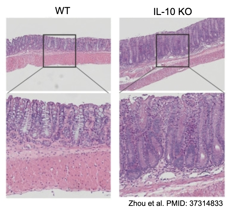 <p>_ is a broadly inhibitory cytokine essential for maintaining self-tolerance and immune homeostasis</p><ul><li><p>Inhibits proinflammatory cytokine production (IL-6, IL-12) by APCs.</p></li><li><p>Suppresses Th1 and Th17 cell differentiation.</p></li><li><p>Promotes Treg differentiation.</p></li><li><p>What about this cytokine makes it effective across so many different cell types?</p></li><li><p>Link to excess inflammation: Deficiency in IL-10 can lead to spontaneous colitis and increased Th17 pathology.</p></li></ul><p></p>