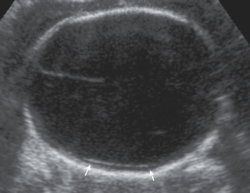 <p>13. Which of the following would be among the list of differential diagnoses for Figure 24-37?</p><p>Figure 24-37</p><p>a. Dandy–Walker variant</p><p>b. Severe ventriculomegaly</p><p>c. Ventriculitis</p><p>d. Mega cisterna magna</p>