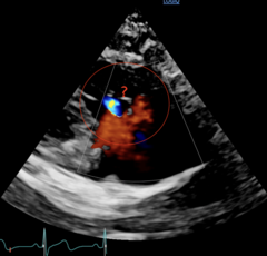 <p>Right Ventricular Inflow Tract (Color)</p>