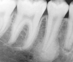 <p>no decay or pulpal involvement, tooth is sound; RO lesion, no RL rim; no cortical expansion </p>