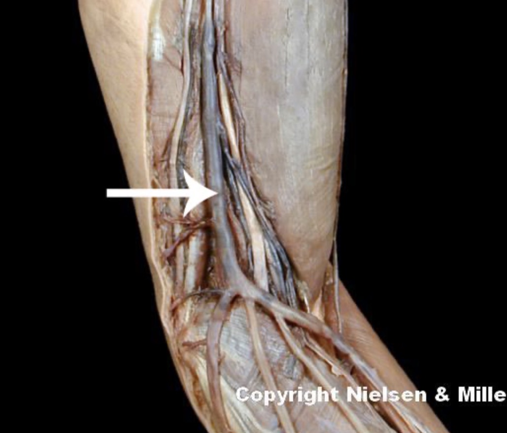 <p>The indicated vessel is the _ (anteromedial view of superficial veins of arm/forearm). It drains the integument and superficial muscles of the _ aspect of the upper limb</p>
