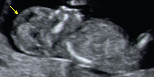 <p>14. What abnormality is indicated by the arrow in Figure 24-38?</p><p>Figure 24-38</p><p>a. Holoprosencephaly</p><p>b. Arnold–Chiari II malformation</p><p>c. Acrania</p><p>d. Trisomy 18</p>
