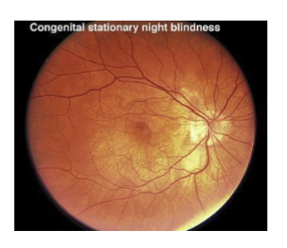 <p>CSNB is a functional neurotransmission disorder, not a degenerative photoreceptor disease.<br>→ Structural retina appears normal on fundus exam, despite profound defects in synaptic signaling between photoreceptors and bipolar cells.</p>