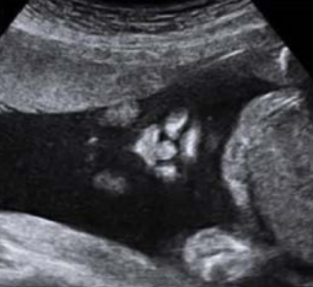 <p>What is being depicted in this image?</p><p>a. Cleft lip</p><p>b. Cleft palate</p><p>c. Normal nose/lips</p><p>d. Proboscis</p>