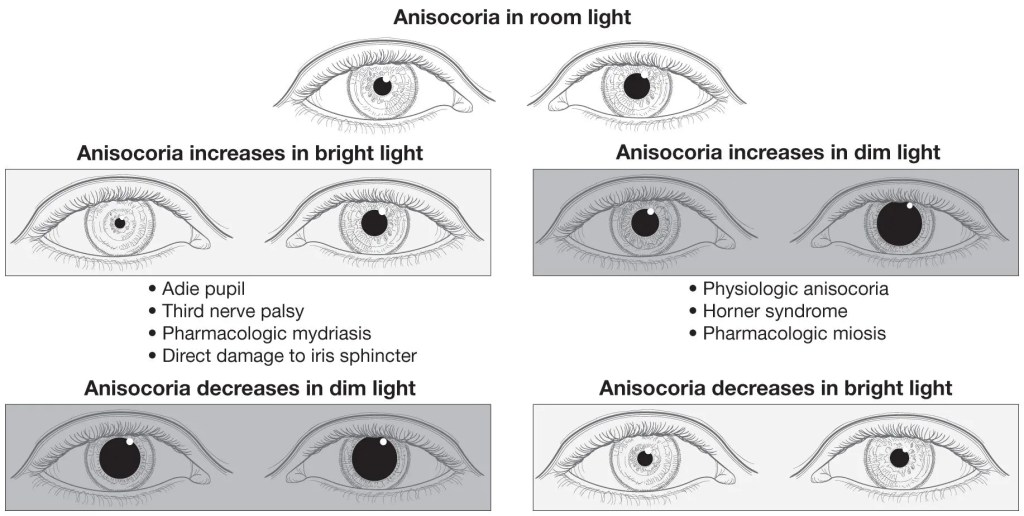 <p>PP: pupillary diameter difference of 0.4+mm</p><p>E: 20%→healthy→rarely exceeds 1mm</p><p>PE: bright+dim light=equal+brisk constriction to light→normal</p>