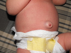 <p>Herniation of abd content through umbilical opening from failure of umbilical ring to close. Diagnosed clinically.</p><p>Most require observation and close spontaneously by age 5.</p>