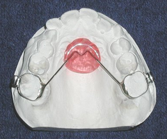 <p>what space maintainer:</p><p> - Upper arch</p><p>- Acrylic button utilizes tissue support to maintain molar position and prevent mesial drift</p><p>- Can cause gingival irritation</p>