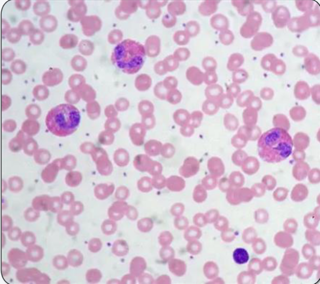 <p>What is the name for this granulocytic condition? What are the most common causes 1) worldwide and 2) in the US?</p>