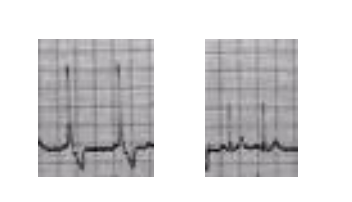<p>What waves on an ECG can be come irregularly tall in cases of DCM? This irregularity is called electrical alternans.</p>
