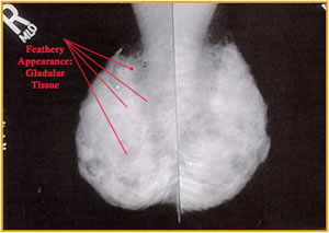 <p>this breasts consists of extensive glandular tissue with minimal adipose tissue since the glands are actively producing milk </p><p><u>the breast is extrenely dense and radioopaque</u></p>