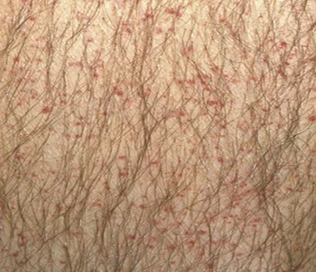 <p>Petechiae</p>