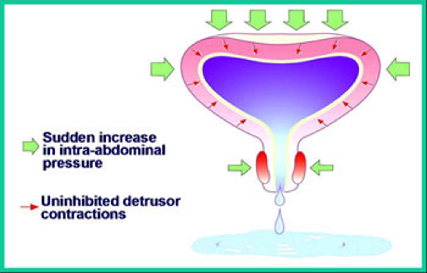 <p>bladder is overactive (contracting) and urethra is underactive (not closing)</p><p>mix of stress (urethra) and urge (bladder overactive)</p>