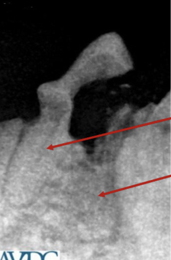 <p>Which tooth resorption stage? What is happening and what should you do?</p>