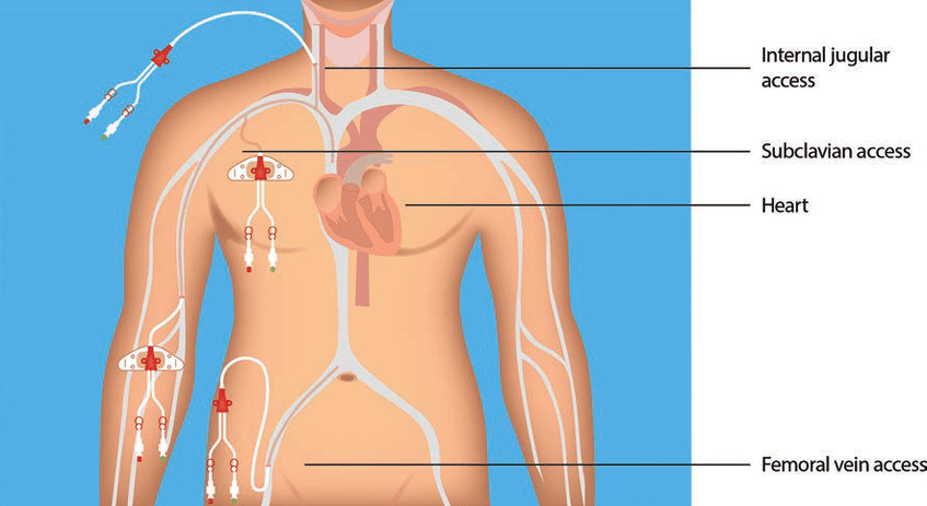 <ul><li><p>IV therapies requiring hemodilation (high osmolarity)</p></li></ul><p>>10% dextrose, hypertonic solutions that damage veins, greater than 600, >5% protein, increase electrolytes</p><ul><li><p>Frequent or prolonged IV (chemo)</p></li><li><p>Frequent blood work or transfusions</p></li><li><p>Large-bore venous access required</p></li><li><p>Pressure monitoring (Central Venous Pressure or cardiac output)</p></li><li><p>Lack of alt. access</p></li><li><p>Incompatible meds/ medicated gtts</p></li></ul><p></p>