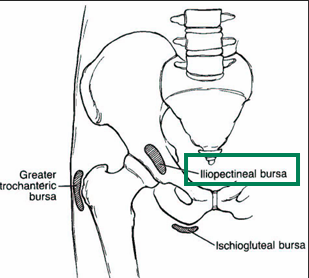 <p><span style="color: red;"><strong>Iliopectineal Bursitis</strong></span></p>