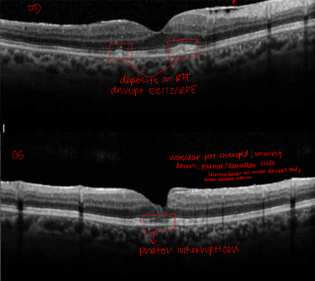 <p>OD: ERM present, depositons on RPE, disruption of EZ/IZ/RPE</p><p>OS: macular pitt (missing layers)/partial lamellar hole (inferferes with inner layers only, outer layers normal), photor diruption</p>