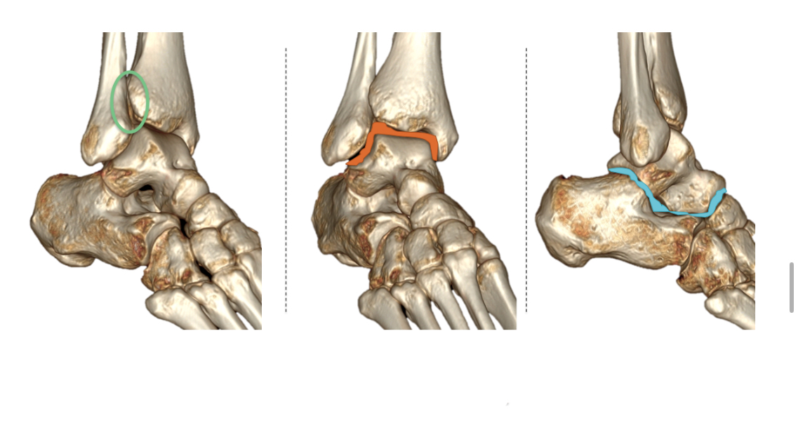 <p>Where is the <span><span>Talocrural Joint</span></span></p>